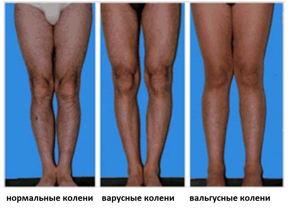 вальгусные, варусные и нормальные колени
