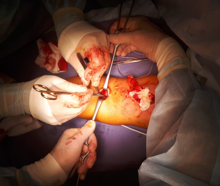 отрыв бицепса плеча операция