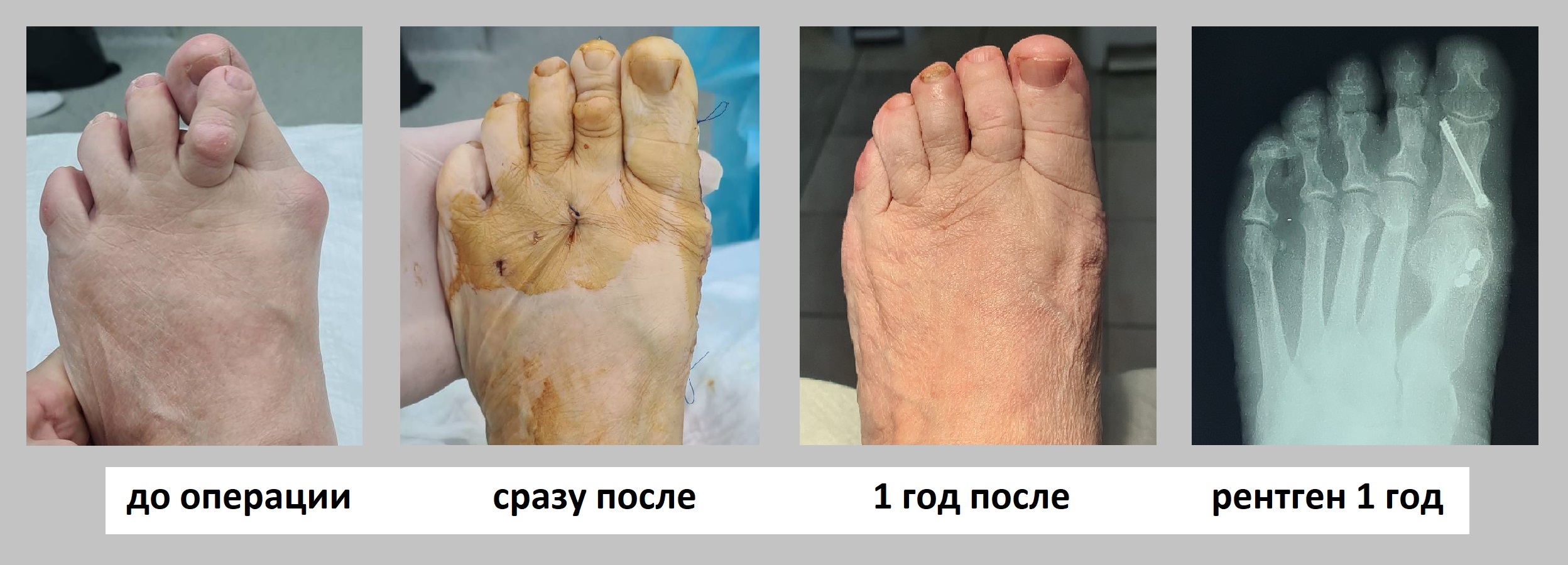 косточка на большом пальце ноги операция