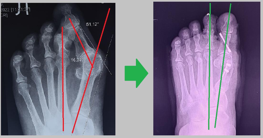 шишка на ноге рентген
