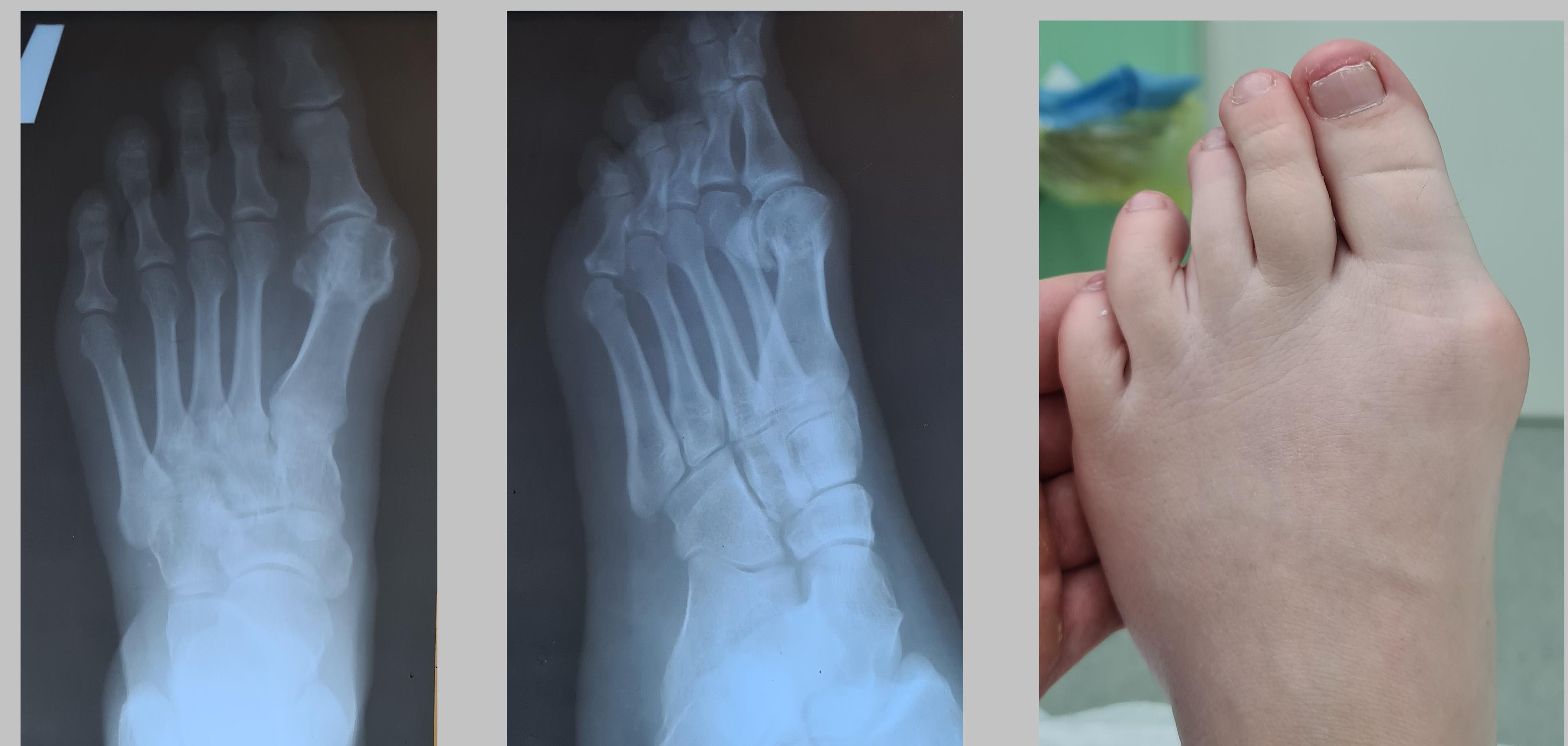 косточка на большом пальце ноги операция 2023