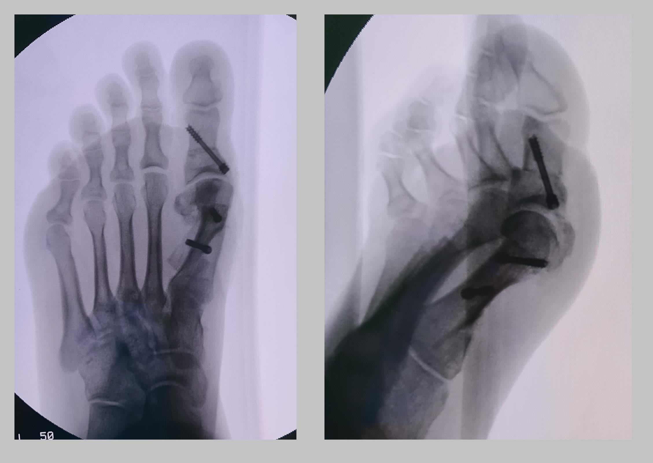 косточка на большом пальце операция рентген
