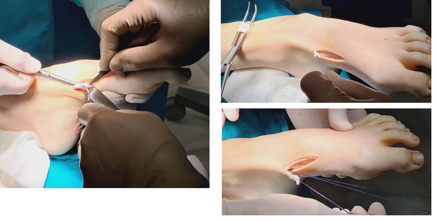 операция при полой стопе, транспозиция сухожилия передней большеберцовой мышцы