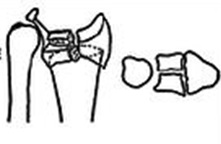 оскольчатый внутрисуставной перелом лучевой кости схема