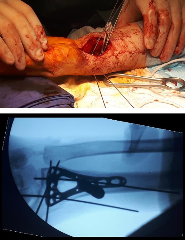 перелом луча в типичном месте операция