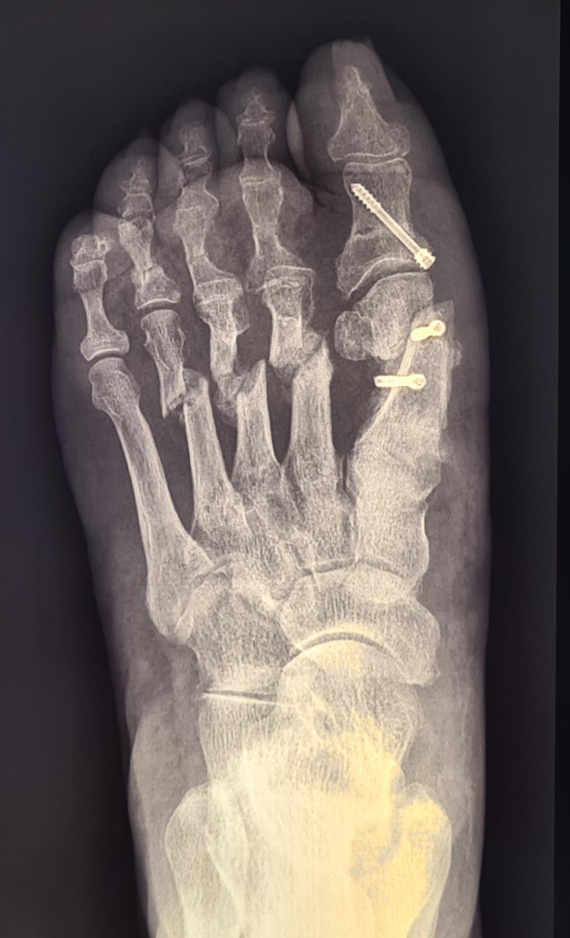 косточка на стопе операция рентген