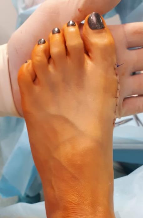 косточка на большом пальце стопы после операции