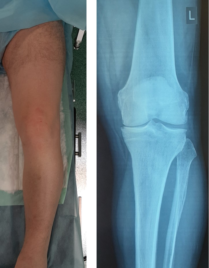 артроз коленного сустава, варусная деформация, боль в колене