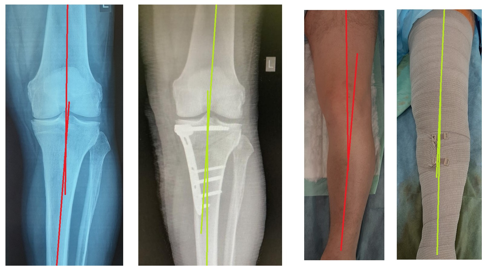лечение артроза коленного сустава, корригирующая остеотомия