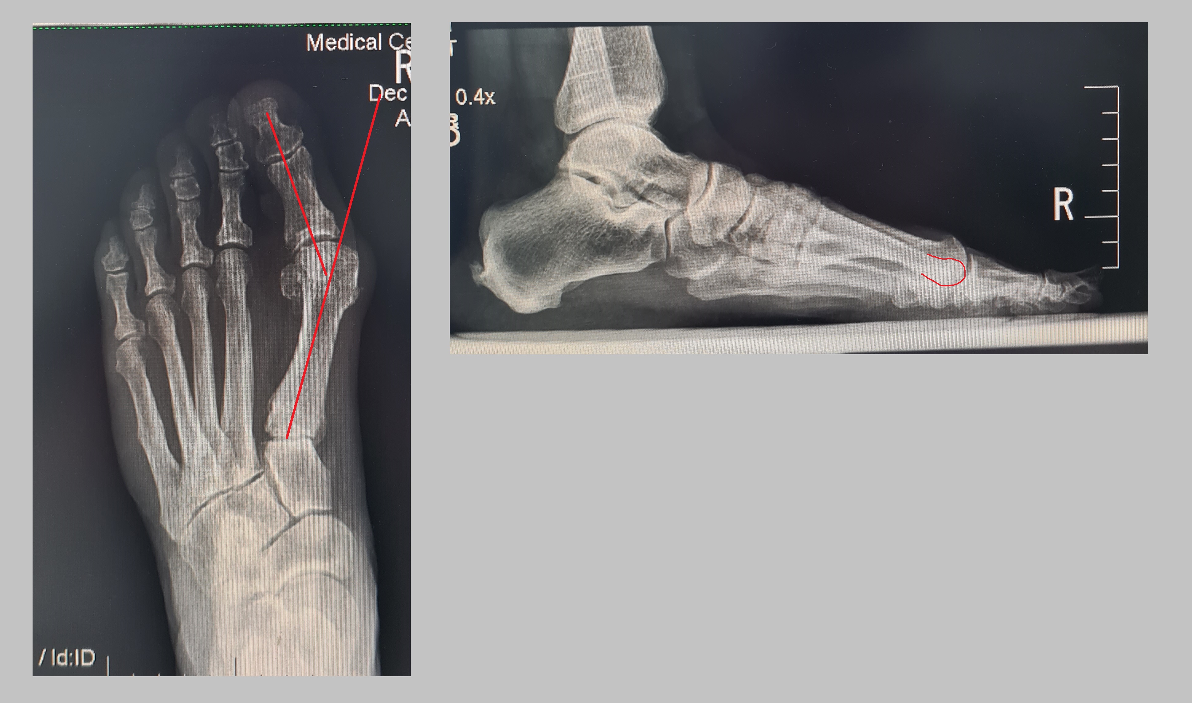 шишка на большом пальце ноги рентген