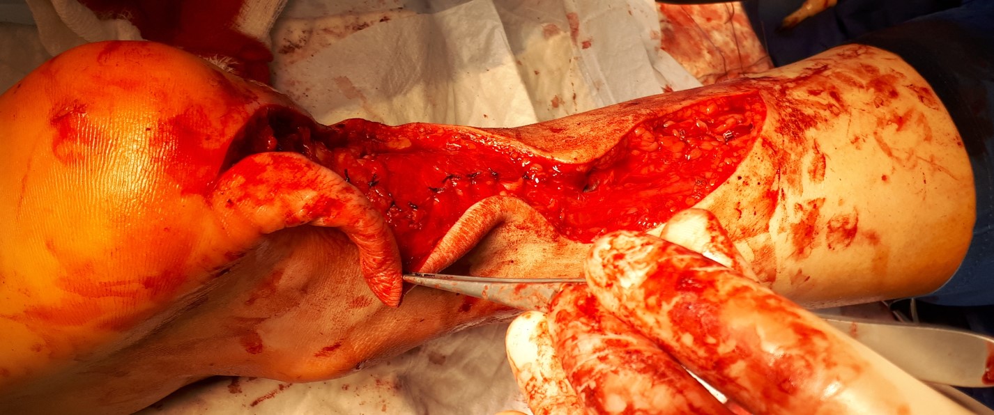 ушивание паратенона после пластики ахиллова сухожилия