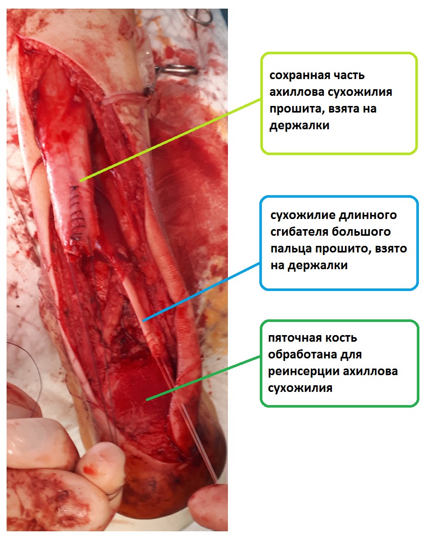 трансфер сухожилия сгибателя большого пальца при дефиците тканей ахиллова сухожилия