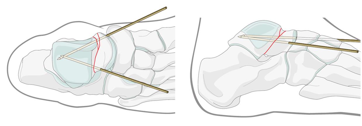 перелом шейки таранной кости операция схема