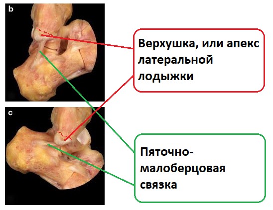 апикальный перелом латеральной лодыжки