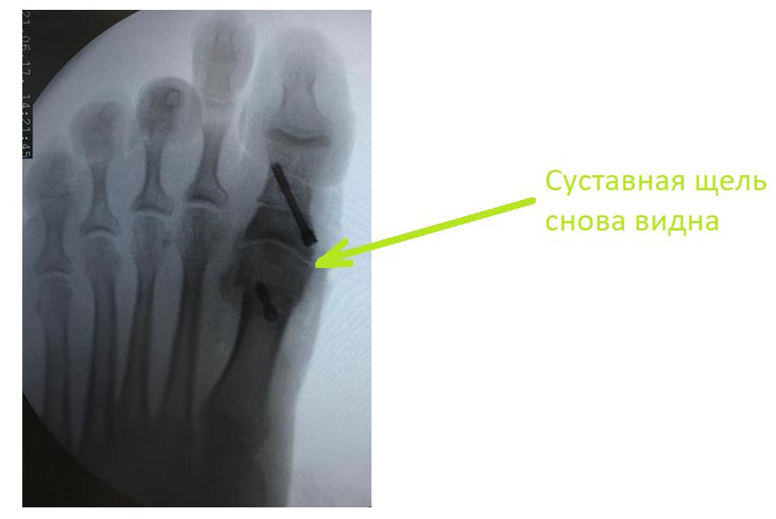 артроз большого пальца стопы операция рентген