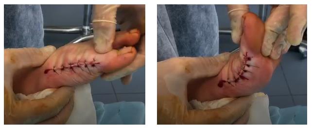 артроз большого пальца стопы операция результат