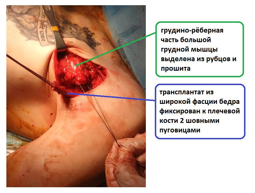 отрыв большой грудной мышцы операция