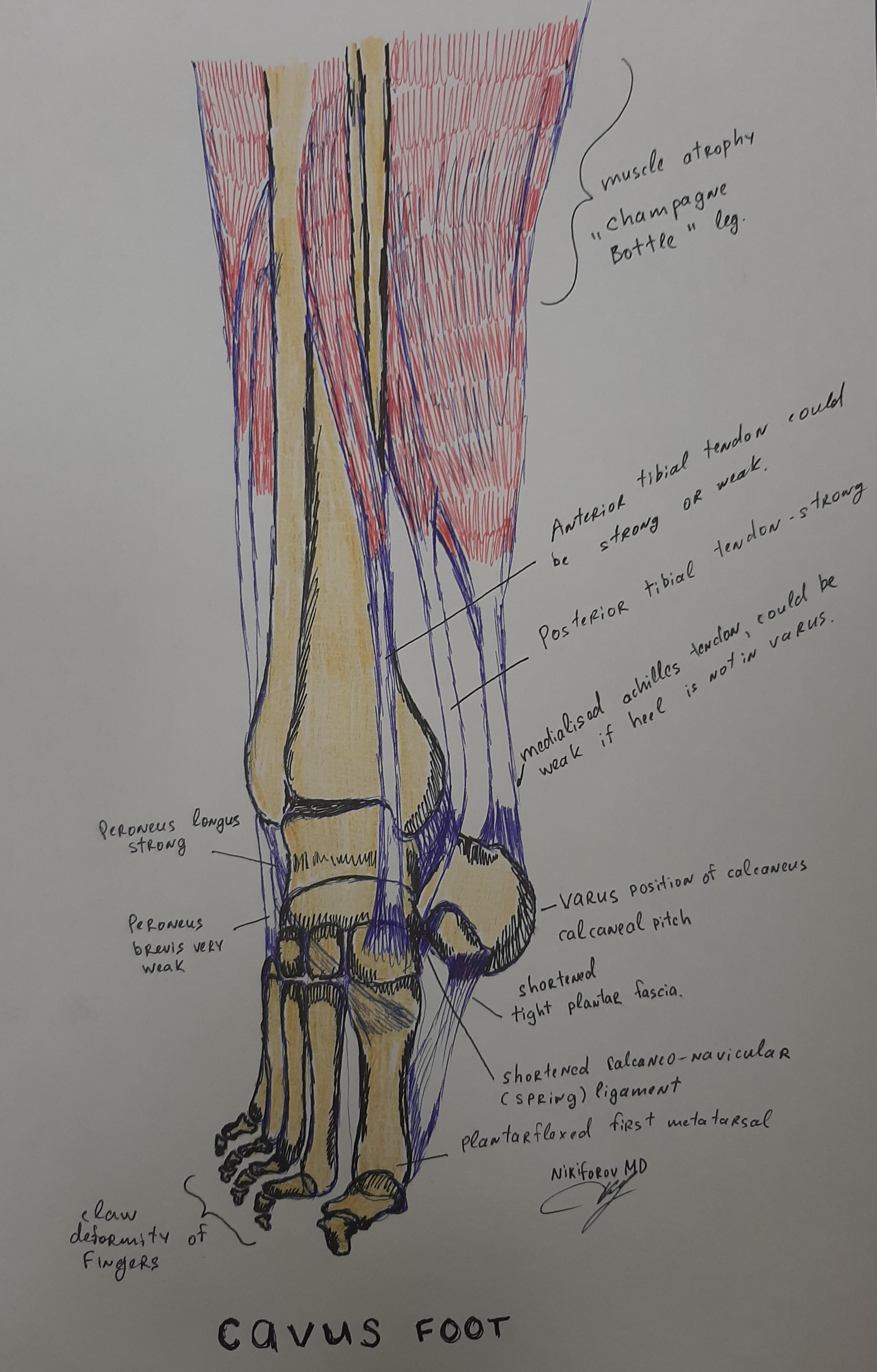 cavus foot anatomy