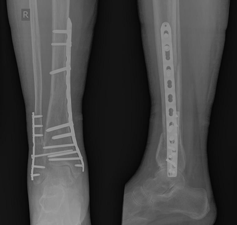 Операция с открытым переломом ноги