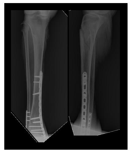 Операции при переломах ноги