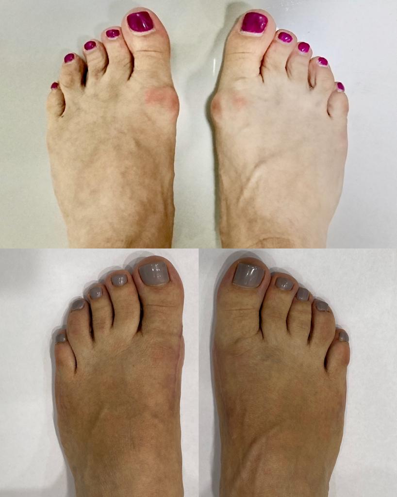 косточка на большом пальце ноги лечение 1