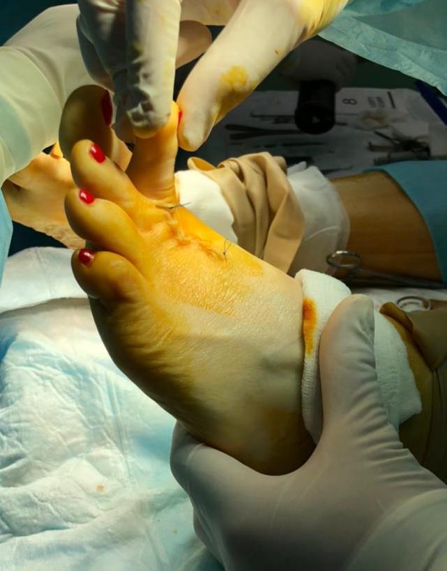 косточки на ногах операция
