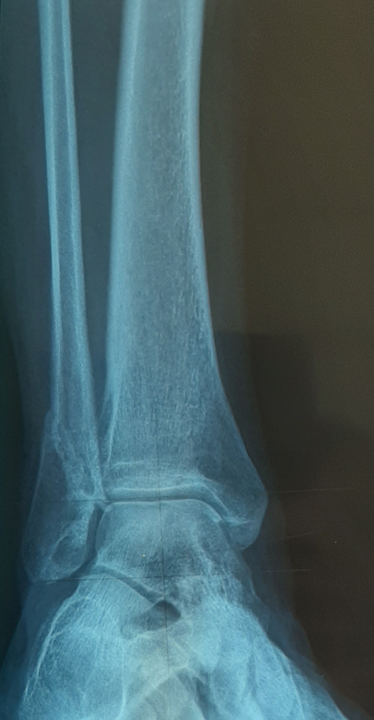 перелом наружной лодыжки рентген