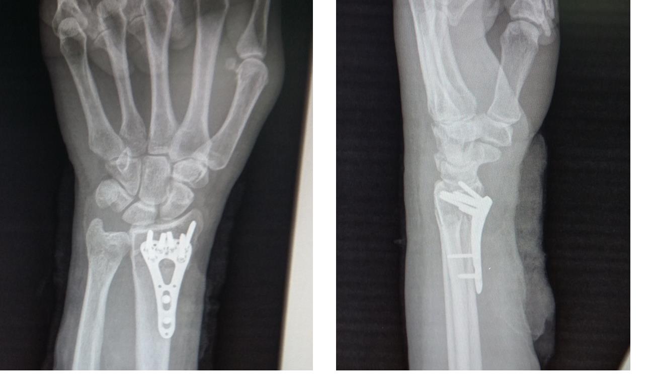 перелом лучевой кости рентген после операции