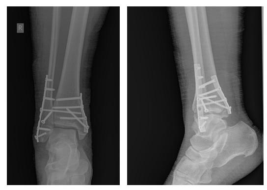 перелом ноги операция