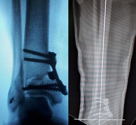 Нестабильность голеностопного сустава рентген после операции