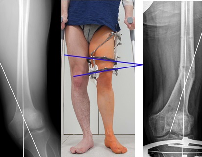 исправление кривизны ноги аппаратом фото и рентген