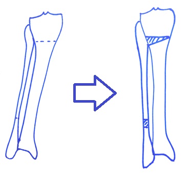 коррекция вальгусной деформации ног схема