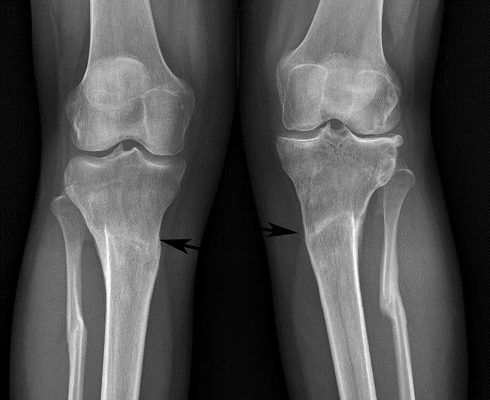 Correction of valgus knee ilizarov technique