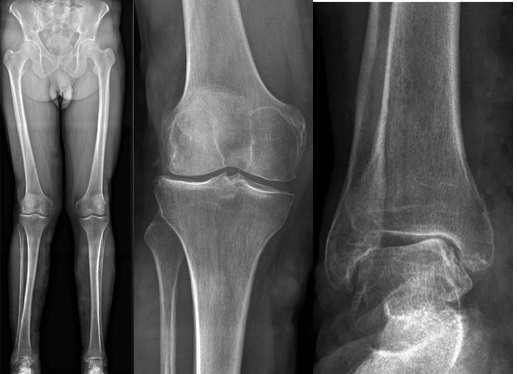 компенсаторная деформация голеностопного сустава при вальгусе колена