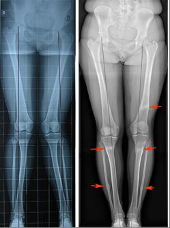 рентгенограммы после хирургической коррекции кривизны ног