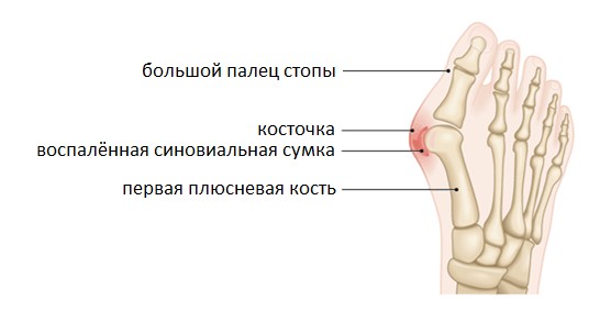 Операция на косточке большого пальца ноги
