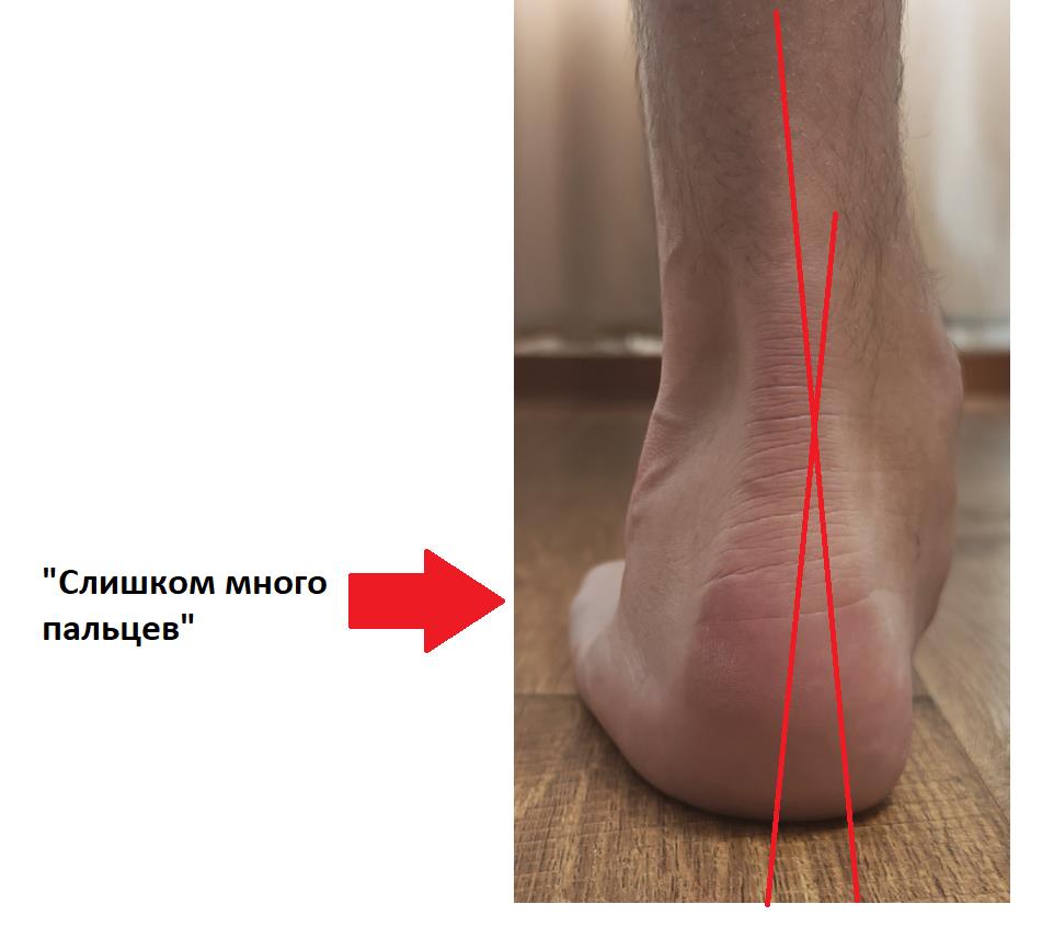 плосковальгусная деформация
