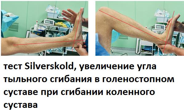 эквинусная контрактура