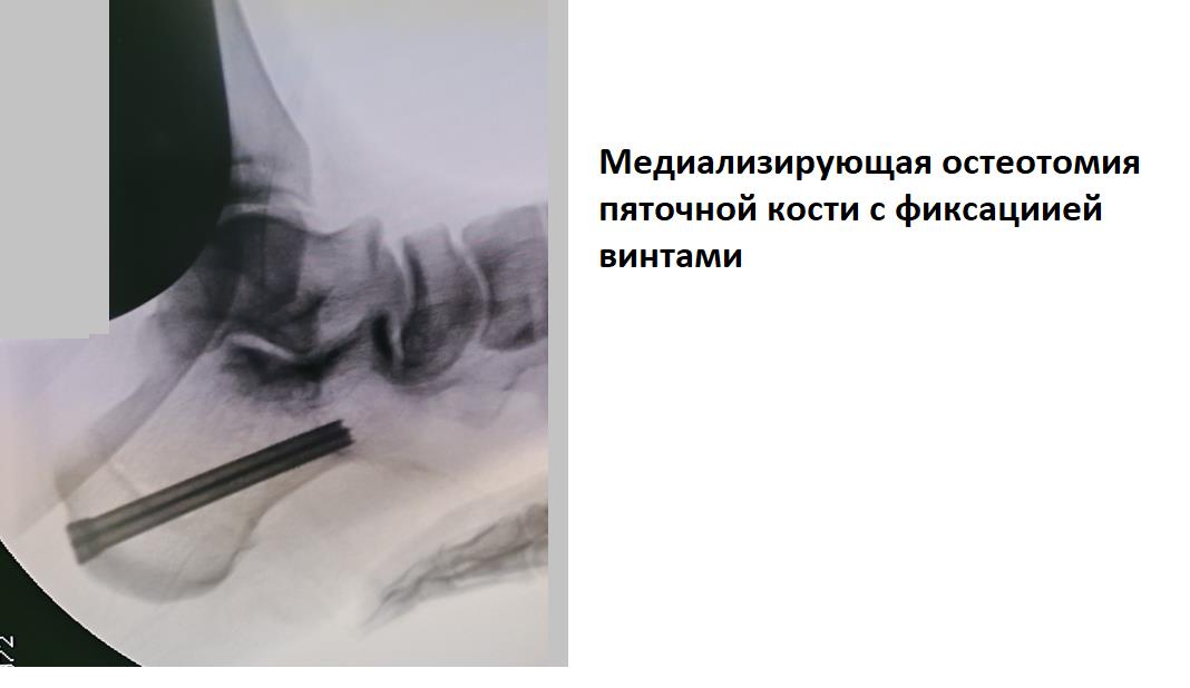 остеотомия пяточной кости при плоскостопии