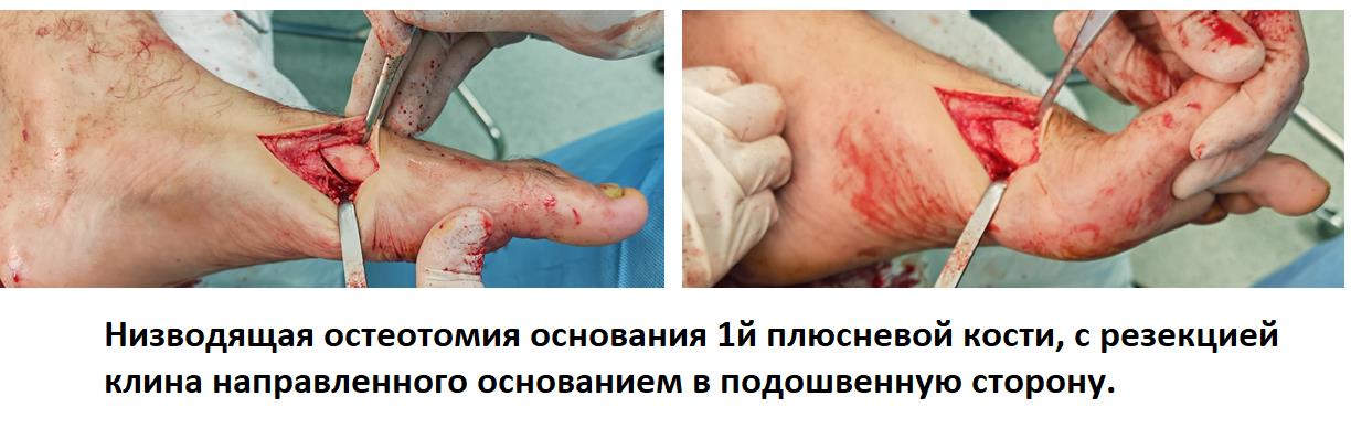остеотомия 1 плюсневой кости при плоскостопии