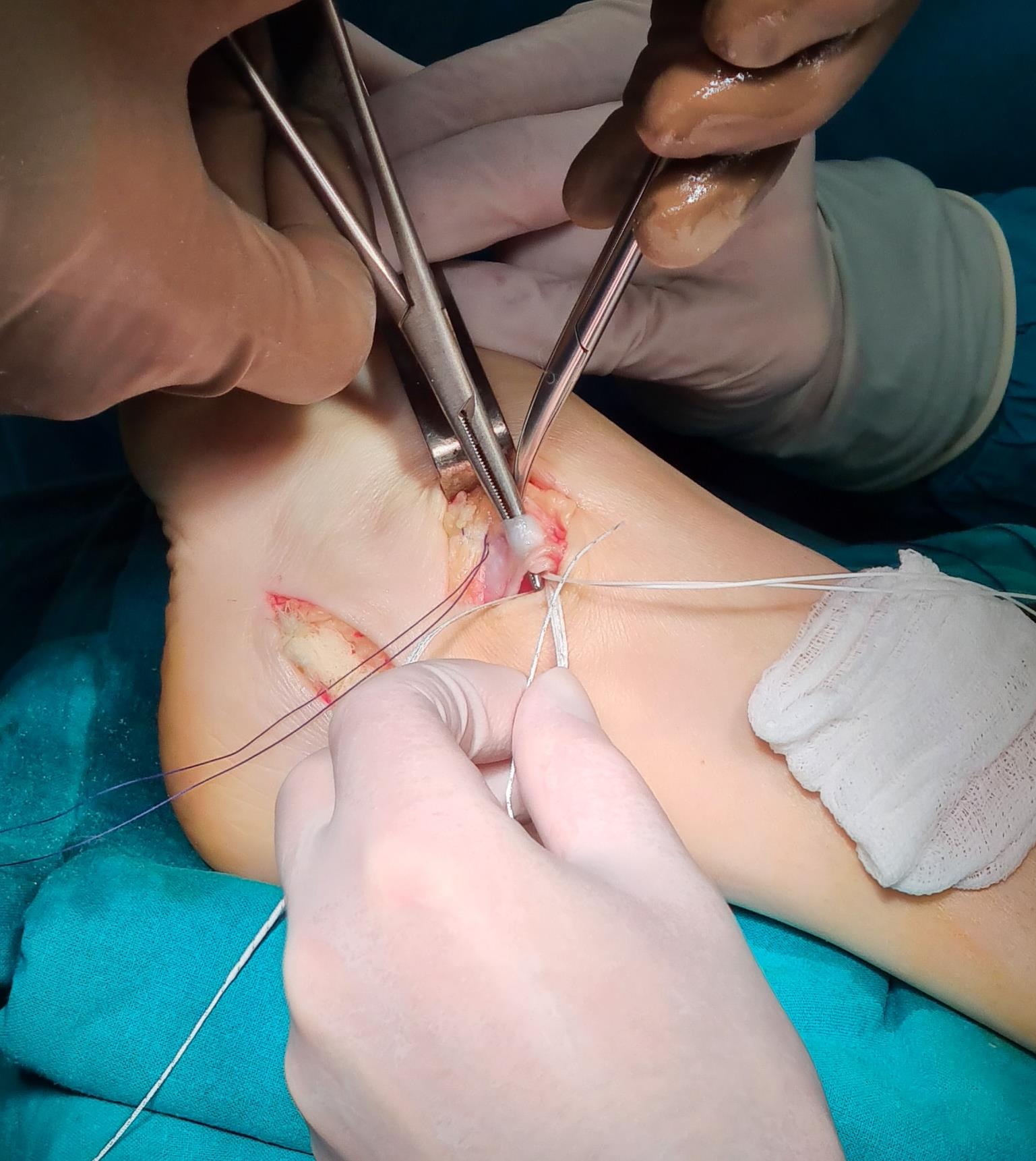 стабилизация голеностопного сустава при помощи синтетического импланта 