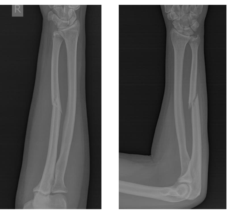 перелом локтевой кости рентген