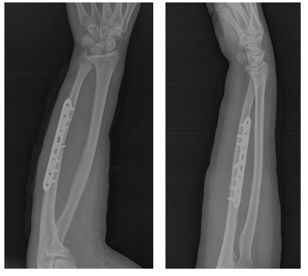 остеосинтез локтевой кости пластиной и винтами рентген
