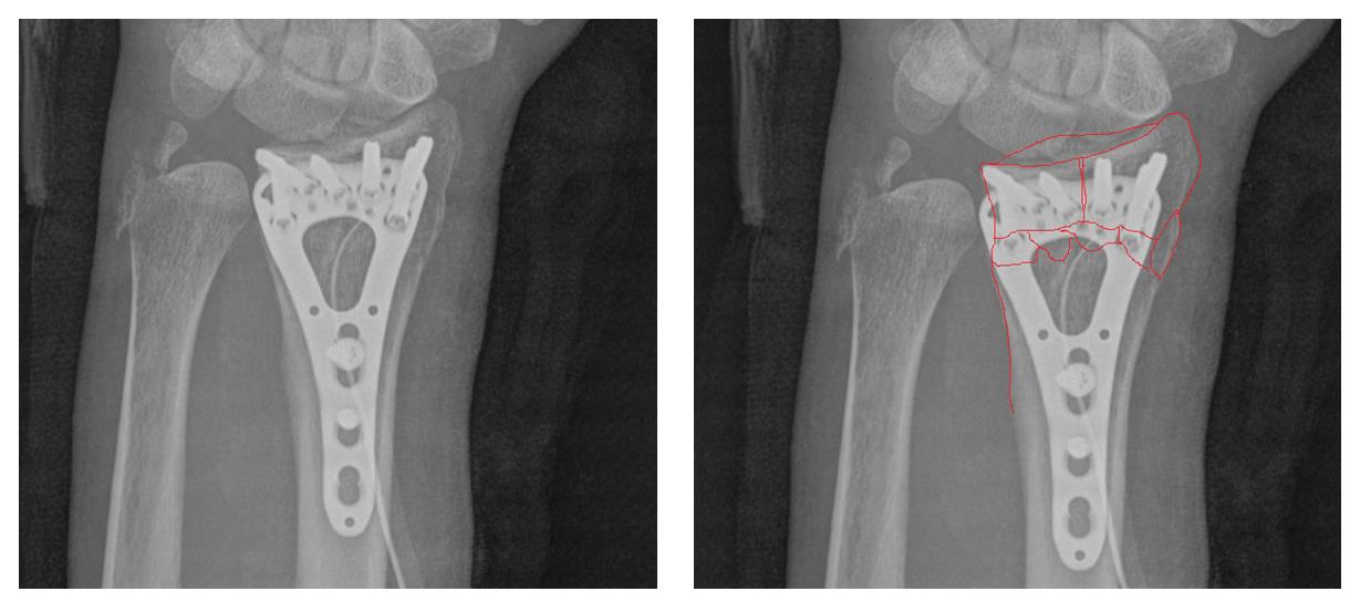 перелом луча в типичном месте рентген