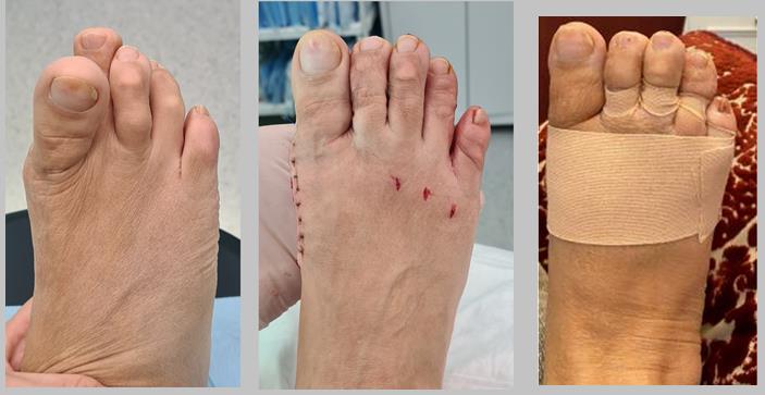 операция при рецидиве косточки на большом пальце ноги