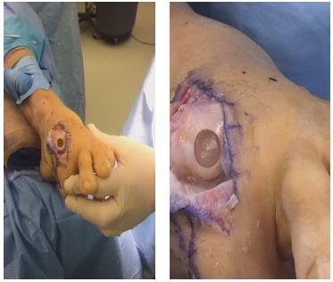 Артроз первого плюснефалангового сустава операция