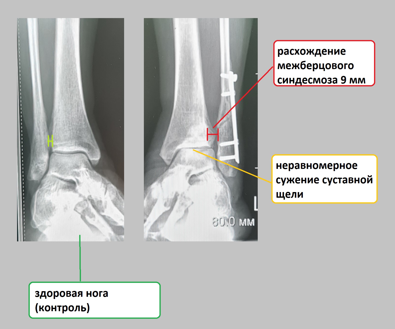 разрыв межберцового синдесмоза лечение