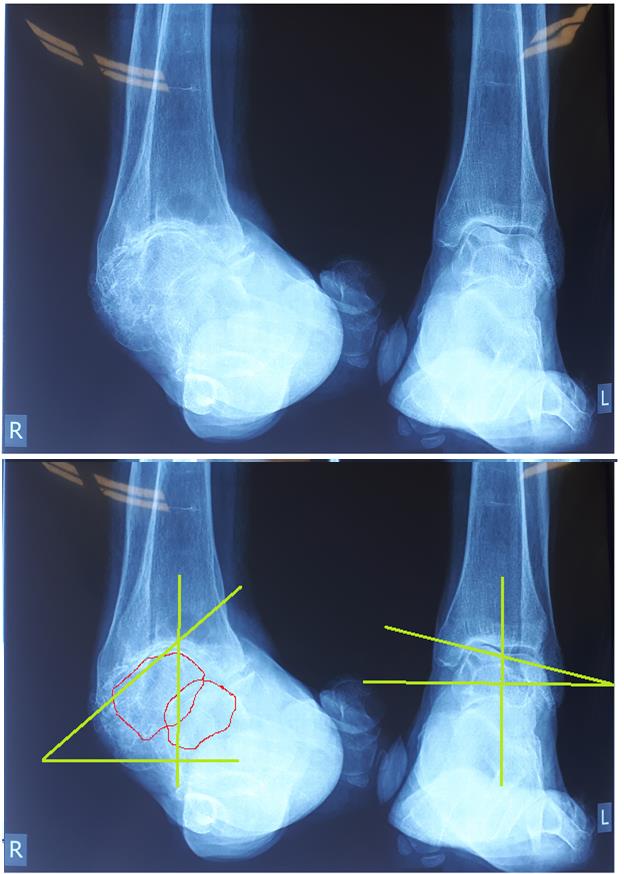 артроз голеностопа рентген перед операцией