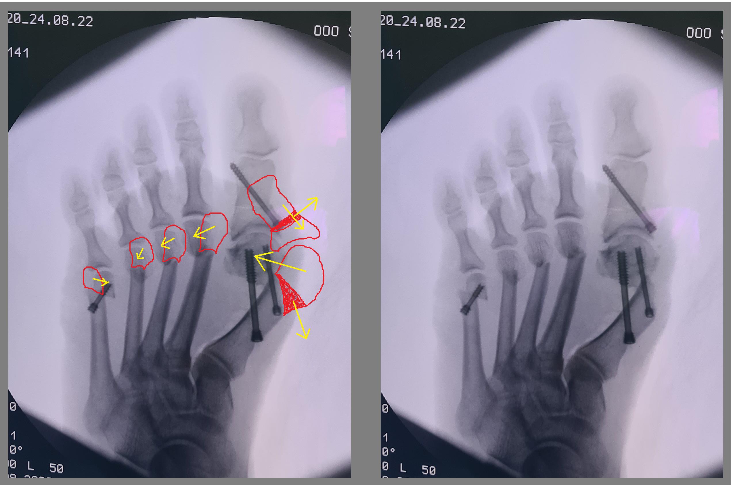 косточка на большом пальце операция рентген