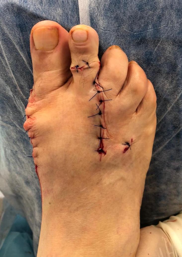 косточка на большом пальце стопы тяжёлый случай операция